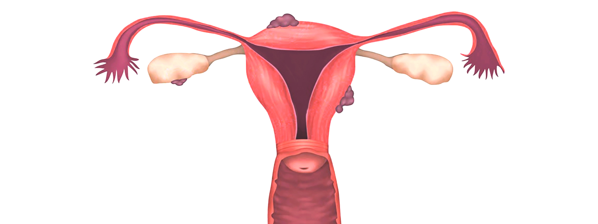 2 Endometrosis