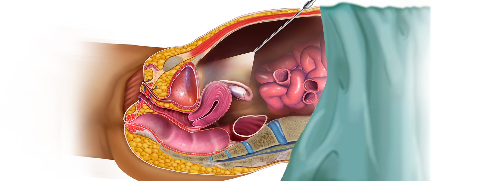 4 Laperoscopy