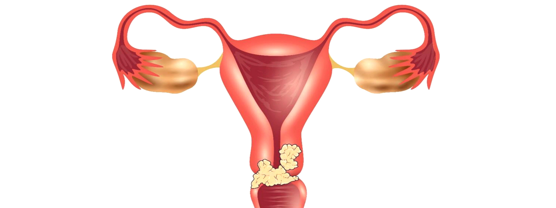 7 Gynec Cancer Care