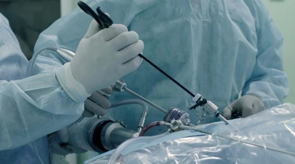 laparoscopy for infertility