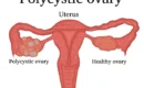 Difference Between PCOS and PCOD