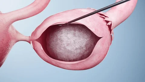 What size ovarian cyst is dangerous