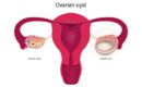 What size ovarian cyst is dangerous