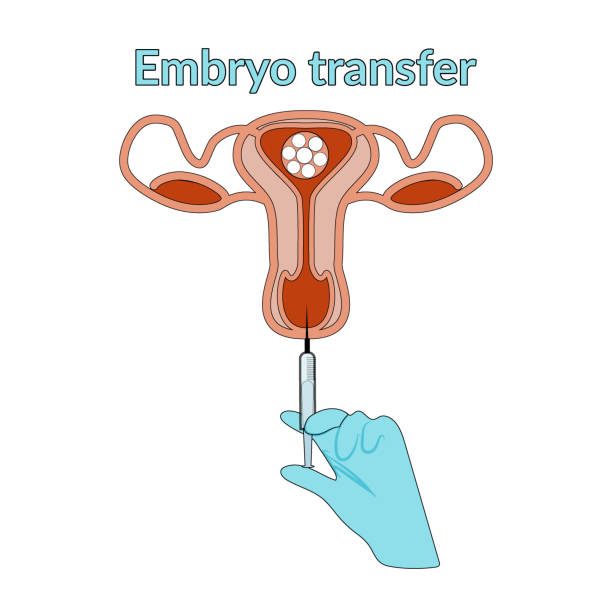 IVF embryo transfer